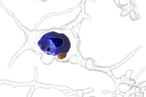 Striatales Neuron mit einem Huntingtin-Aggregat (grün), das mit Ubiquitin-Molekülen (rot) modifiziert und somit von der zellulären Qualitätskontrolle für den Abbau markiert wurde. Zellkern: blau. Aufgenommen mittels Superresolution-Structured-Illumination Microscopy. © Verian Bader